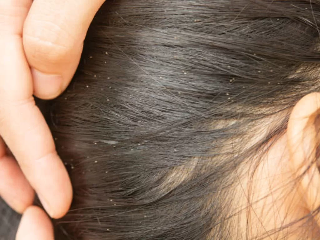 Ilustrasi cara menghilangkan kutu rambut (photo/istock/Srisakorn)
