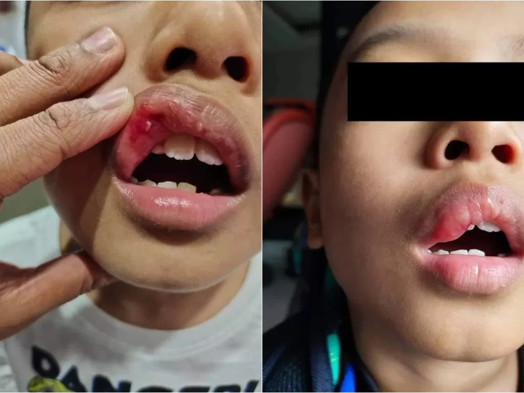 Bibir bocah SD ini bengkak setelah ditampar gurunya (Facebook/Info Roadblock JPJ/POLIS)