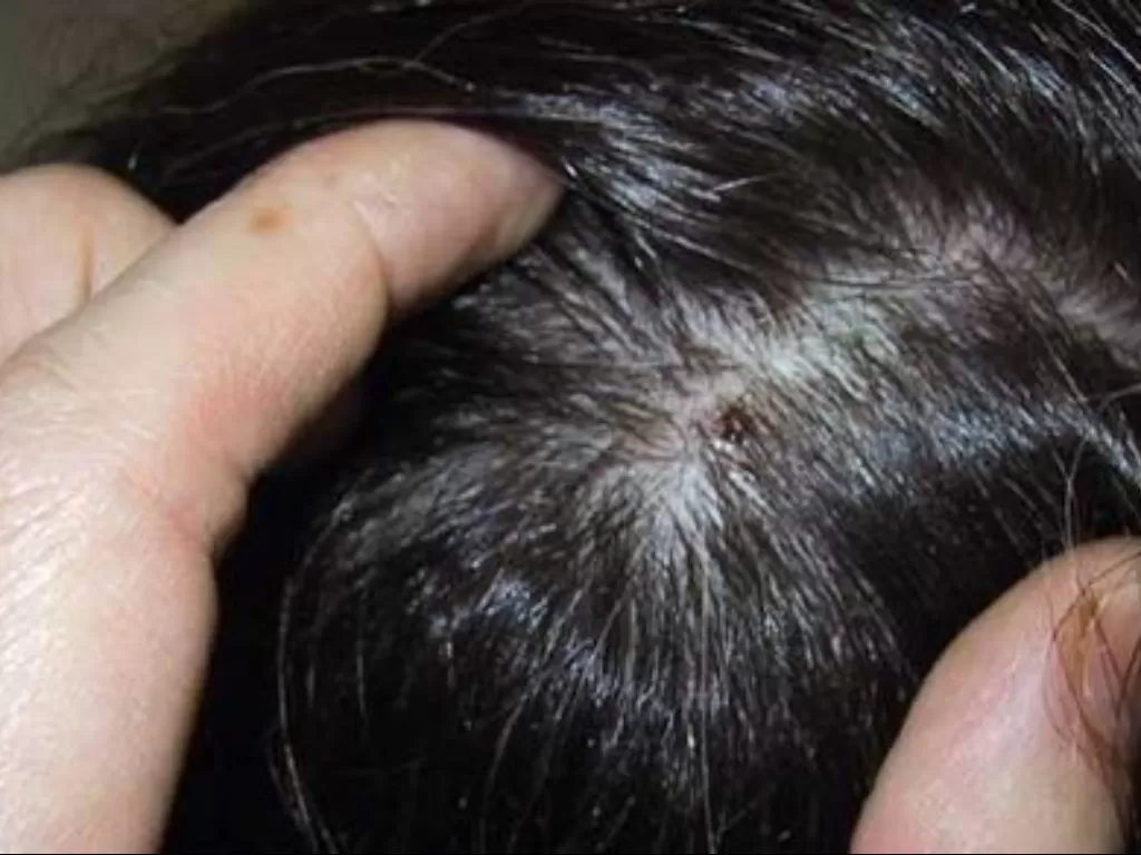 Ilustrasi jerawat di kulit kepala. (pinterest.com)