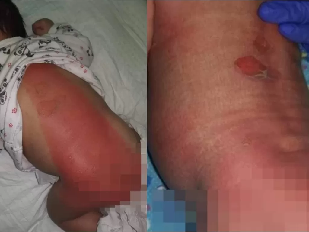 Alami luka bakar setelah pulang dari tempat penitipan anak (Facebook/Info Roadblock JPJ/POLIS)