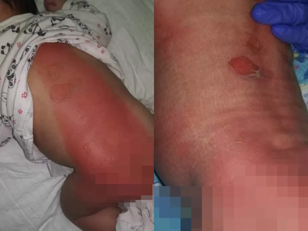 Bekas luka bakar bayi yang berusia 21 hari. (Photo/Facebook/Info Roadblock JPJ/POLIS)