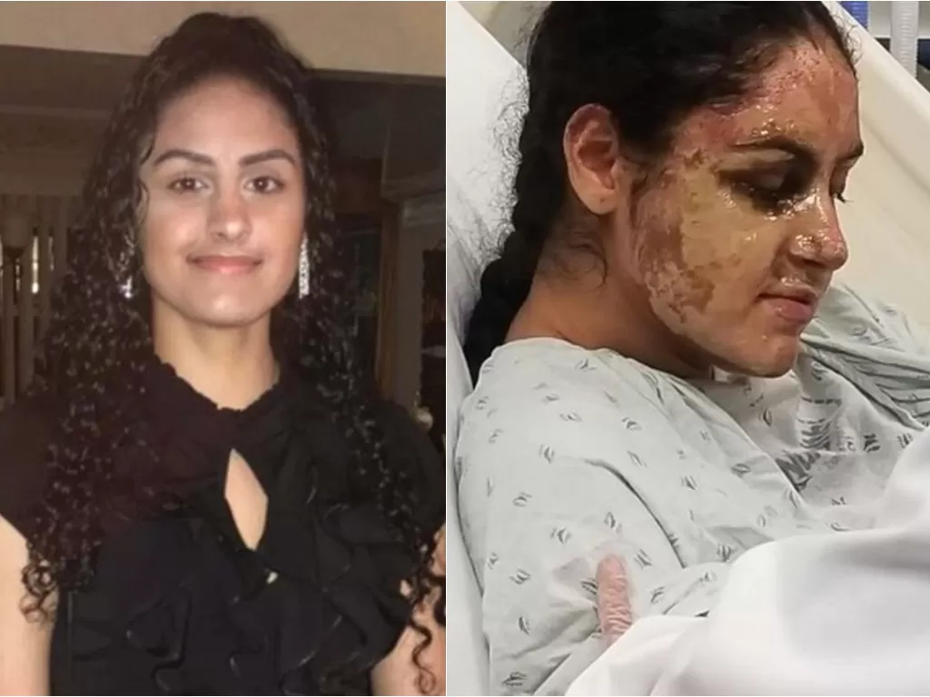Mahasiswi kedokteran yang diserang dengan air asam (Shiekh Ikram/Instagram/@padmalaksmi)
