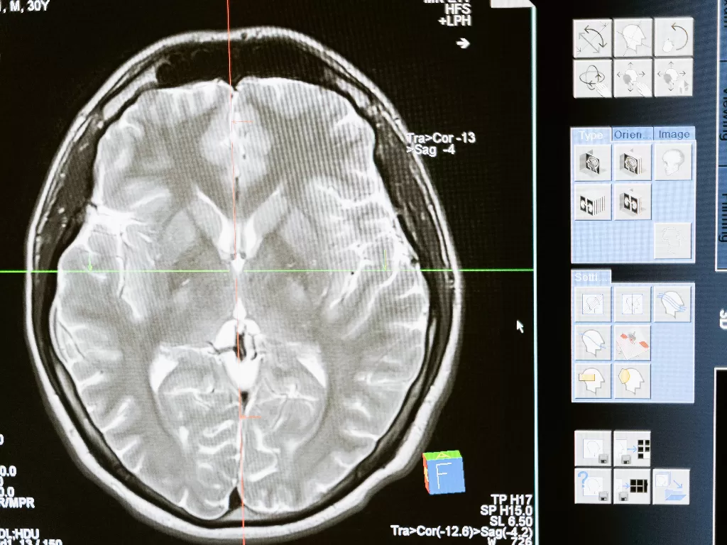 Tampilan hasil CT-Scan otak. (photo/Ilustrasi/Pexels/MART PRODUCTION)