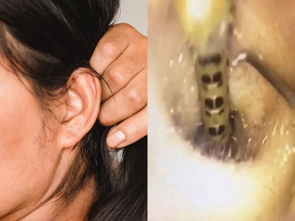 Kiri: Ilustrasi. (Photo/Ilustrasi/Pexels) Kanan: Serangga berbisa di telinga wanita. (Photo/Astro Awani)