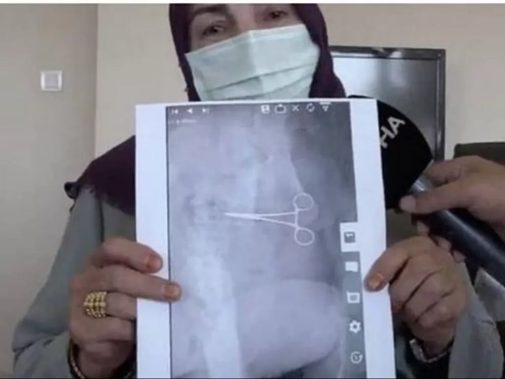 Gunting bedah tertinggal di perut wanita selama 2 bulan usai operasi (Instagram/makasar_info)
