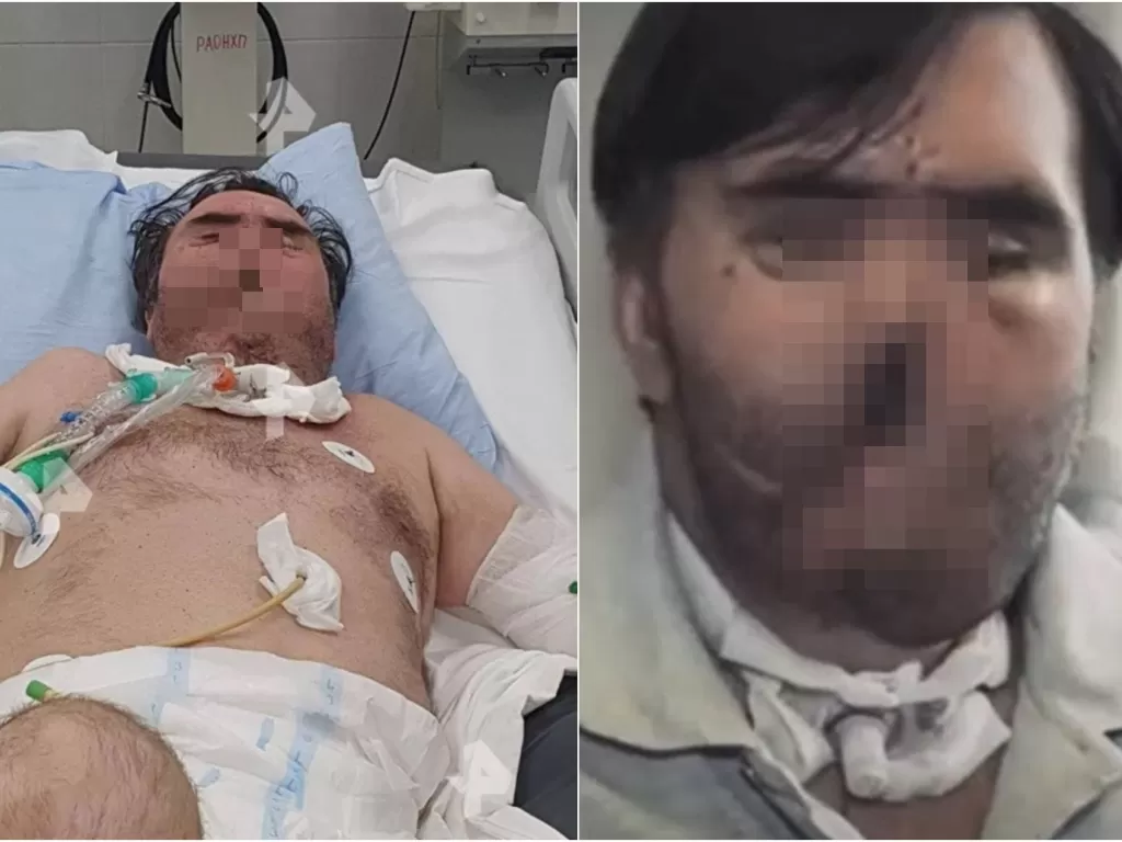 Mikhail Vladimirov (45) meledakkan rahang dan hidungnya dengan senapan. (Rossiya 1)