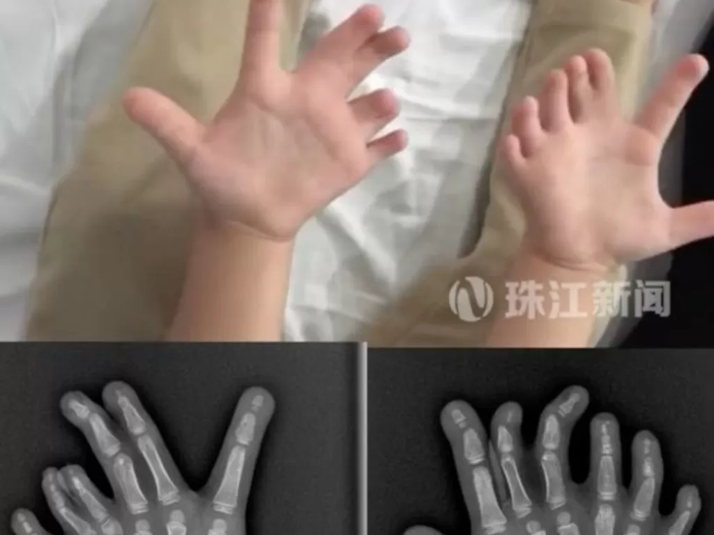 Gadis 4 tahun di China yang punya kelainan pada jari tangan dan kaki. (Douyin/GRTZJXW)