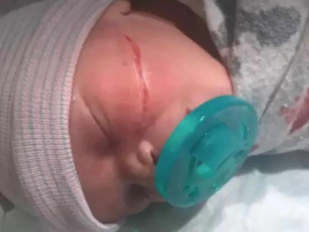 Bayi perempuan lahir dengan luka di wajah. (Fox 31)