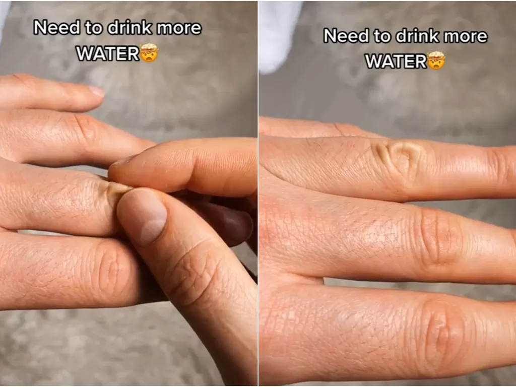 Cubit jari, cara mudah mengetahui apakah kita dehidrasi atau tidak. (TikTok/@remus.bujor)