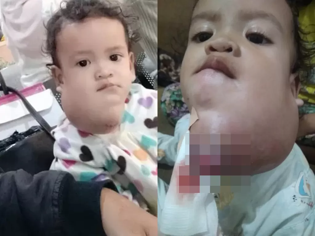 Gadis itu tidak lahir dengan normal karena mengidap tumor leher. (Photo/Yayasan Bantu Tetangga Mulia)