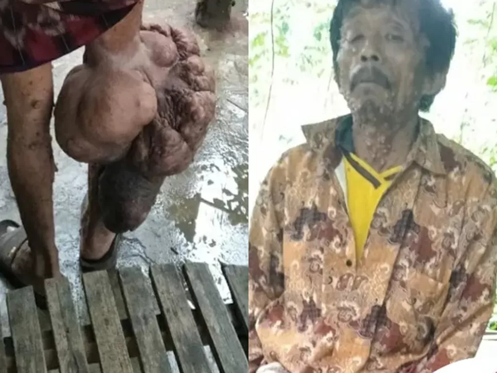 Pria tua yang berusia 50 tahun asal Magelan ini tak bisa operasi karena ekonomi. (Photo/YAYASAN MENGGAPAI RIDHO ILLAHI)