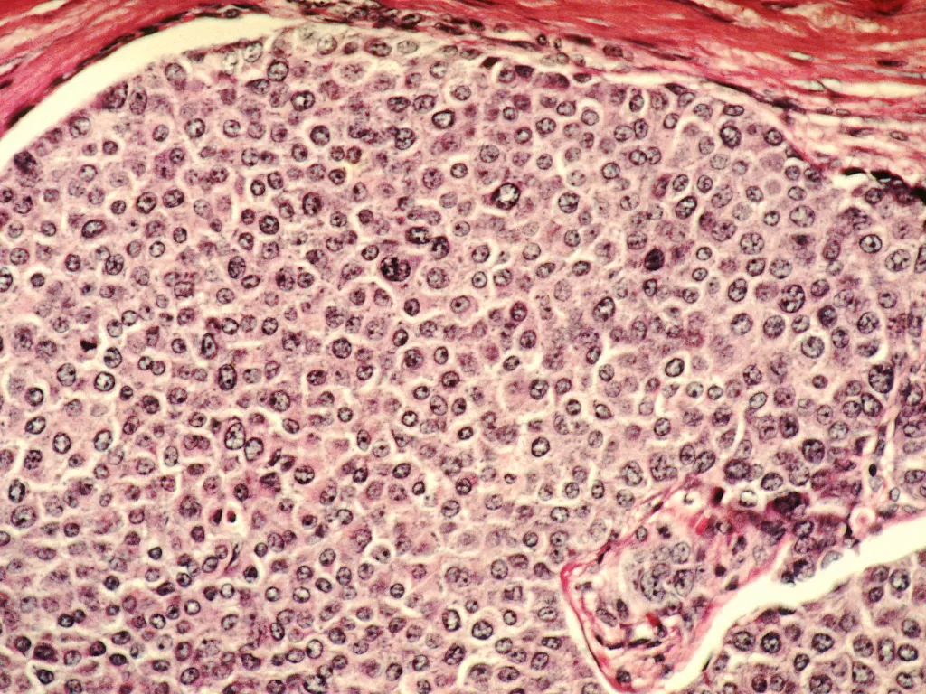 Ilustrasi sel kanker. (photo/Ilustrasi/Dok. Wikipedia)