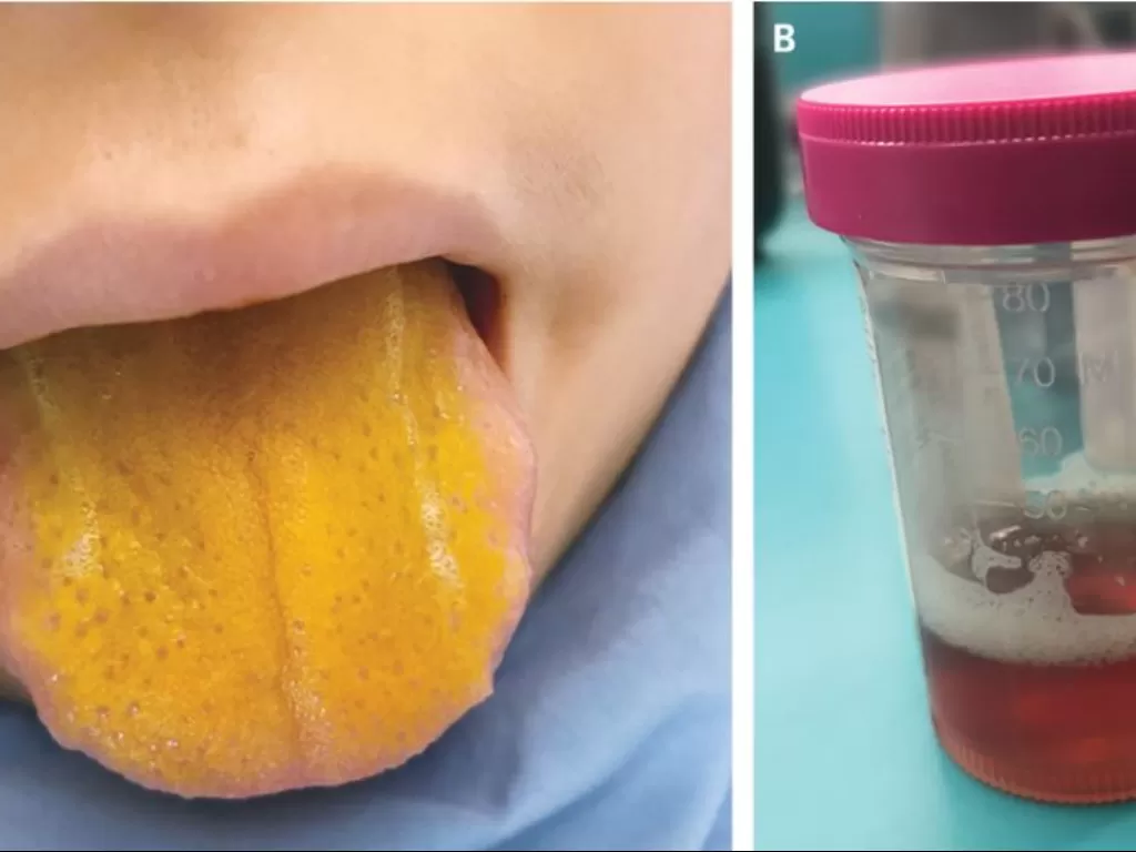 Remaja yang mengalami penyakit kuning dan lidah yang kuning. (photo/Dok. Live Science)
