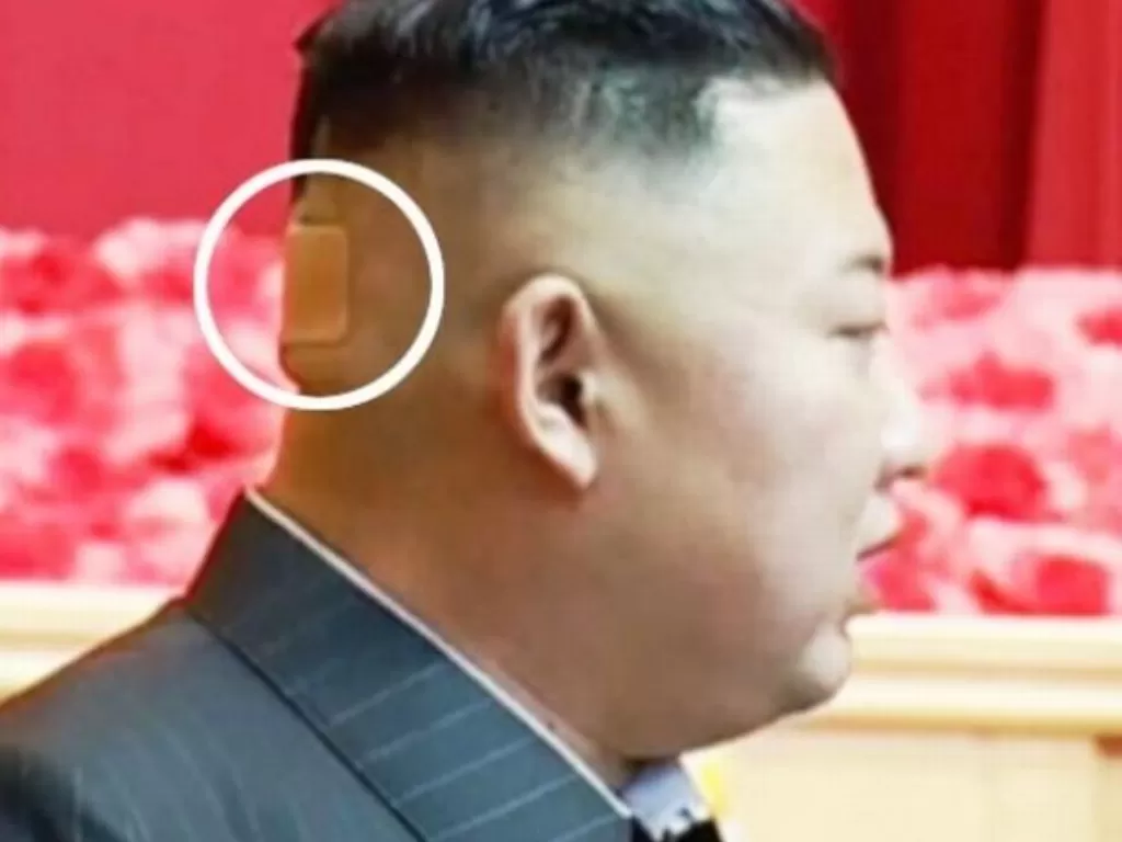 Kim Jong-un terlihat dengan plaster di belakang kepalanya. (KCTV)
