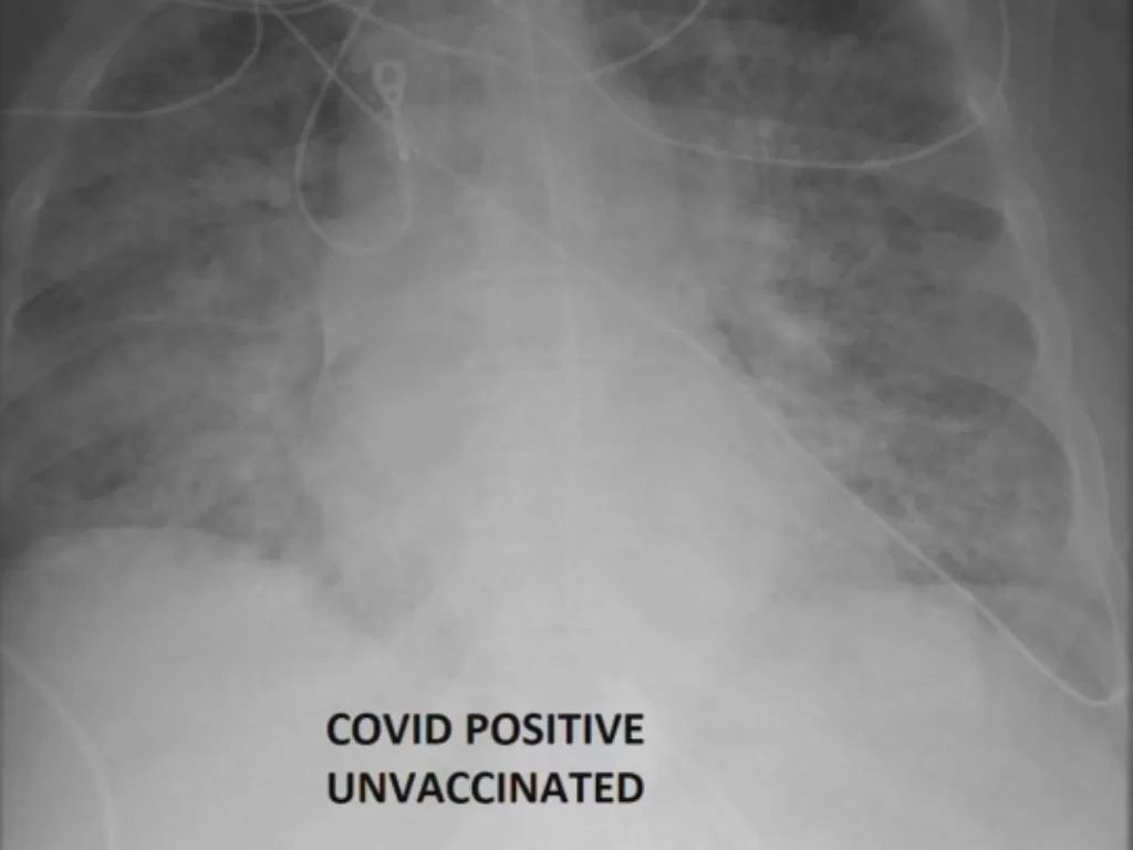 Paru-paru pasien Covid-19 yang belum divaksin (SSM Health)