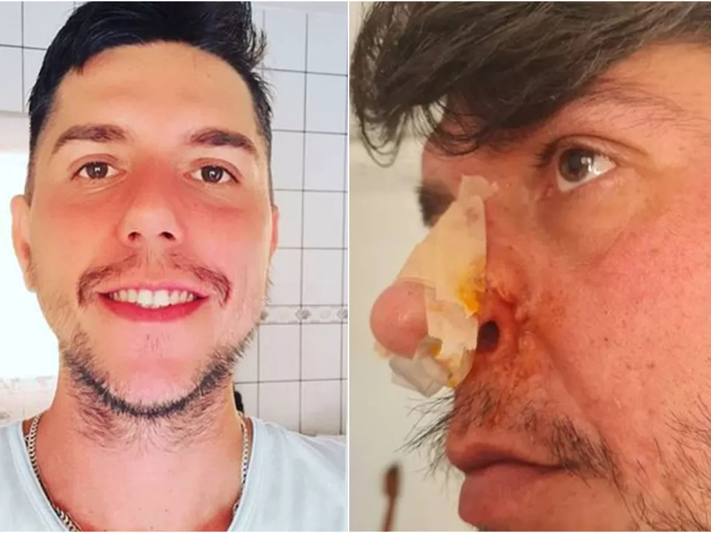 Pria yang punya tiga lubang hidung setelah operasi bibir gagal. (Jam Press)