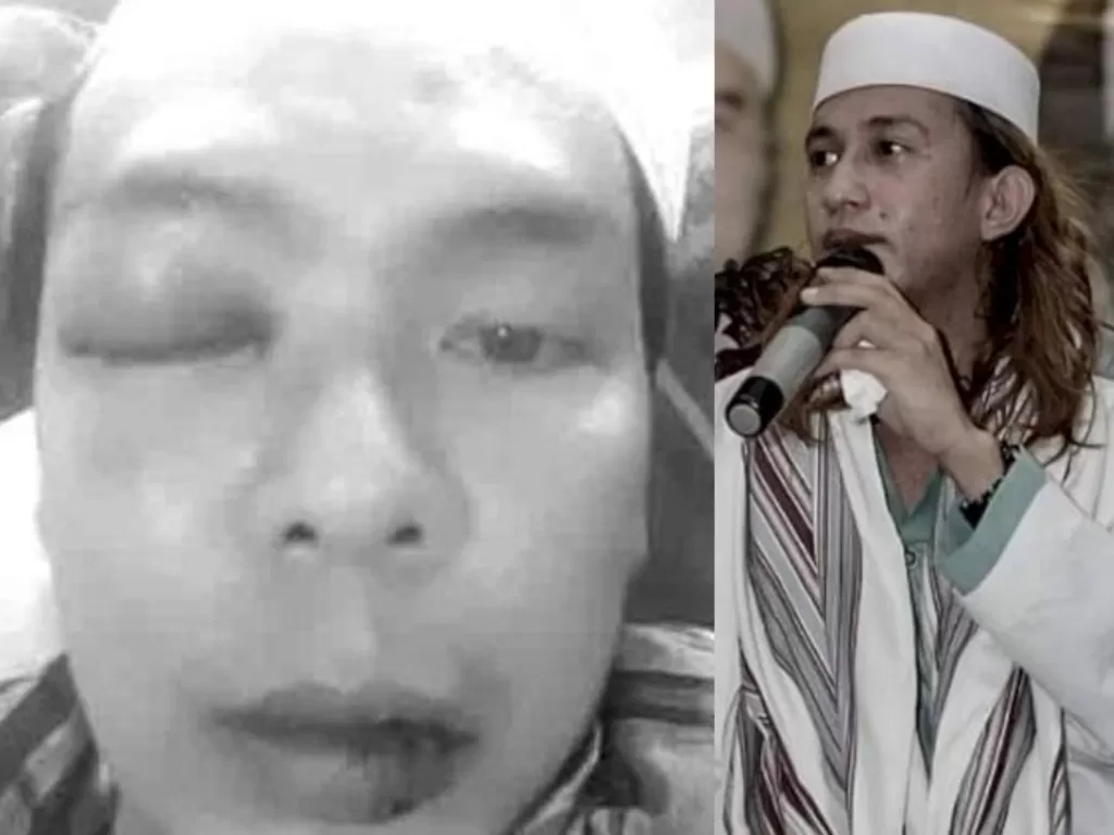 Beredar foto Ryan Jombang babak belur dipukuli Bahar bin Smith. (Istimewa)