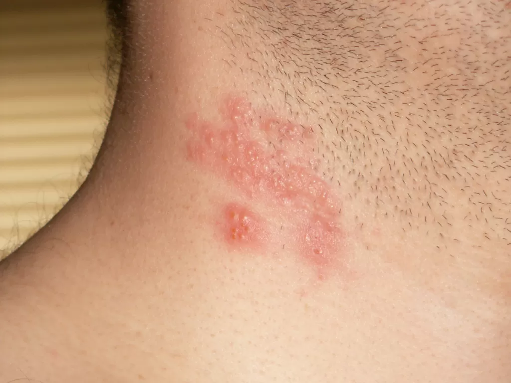 Ilustrasi herpes zoster pada kulit (wikimediacommons)