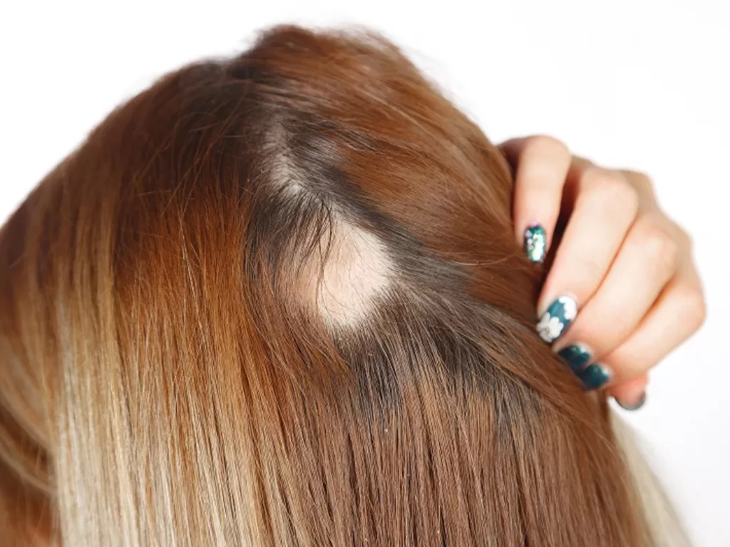 Ilustrasi rambut pitak. (ZAP Clinic)