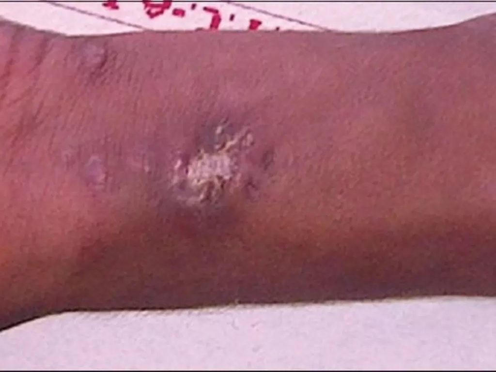 Remaja 15 tahun suntikkan merkuri ke lengannya. (NCBI)