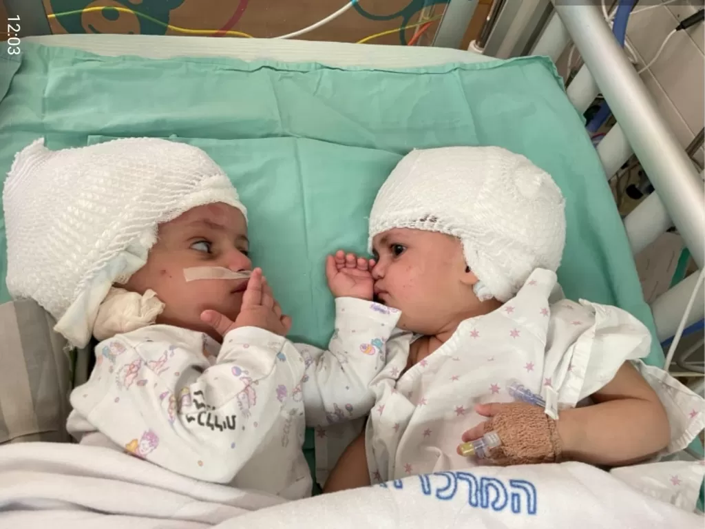 Bayi kembar siam berhasil dipisahkan. (Soroka Medical Centre/Handout via REUTERS)