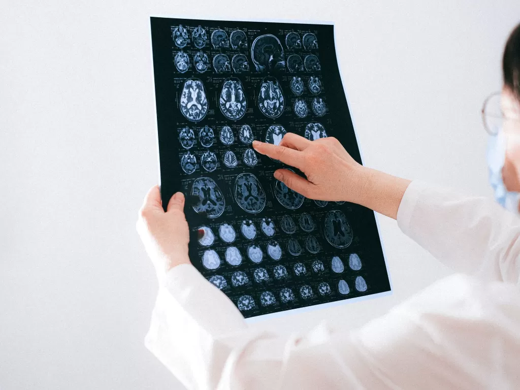 Ilustrasi dokter memegang hasil scan otak. (Pexels/Anna Shvets)