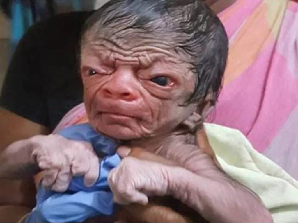 Bayi yang lahir dengan wajah seperti usia 80 tahun (India Today)