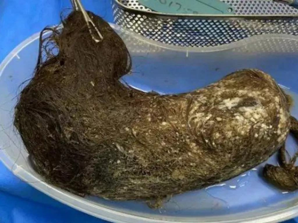Rambut yang ditemukan di dalam perut manusia. (BMJ Case Reports)