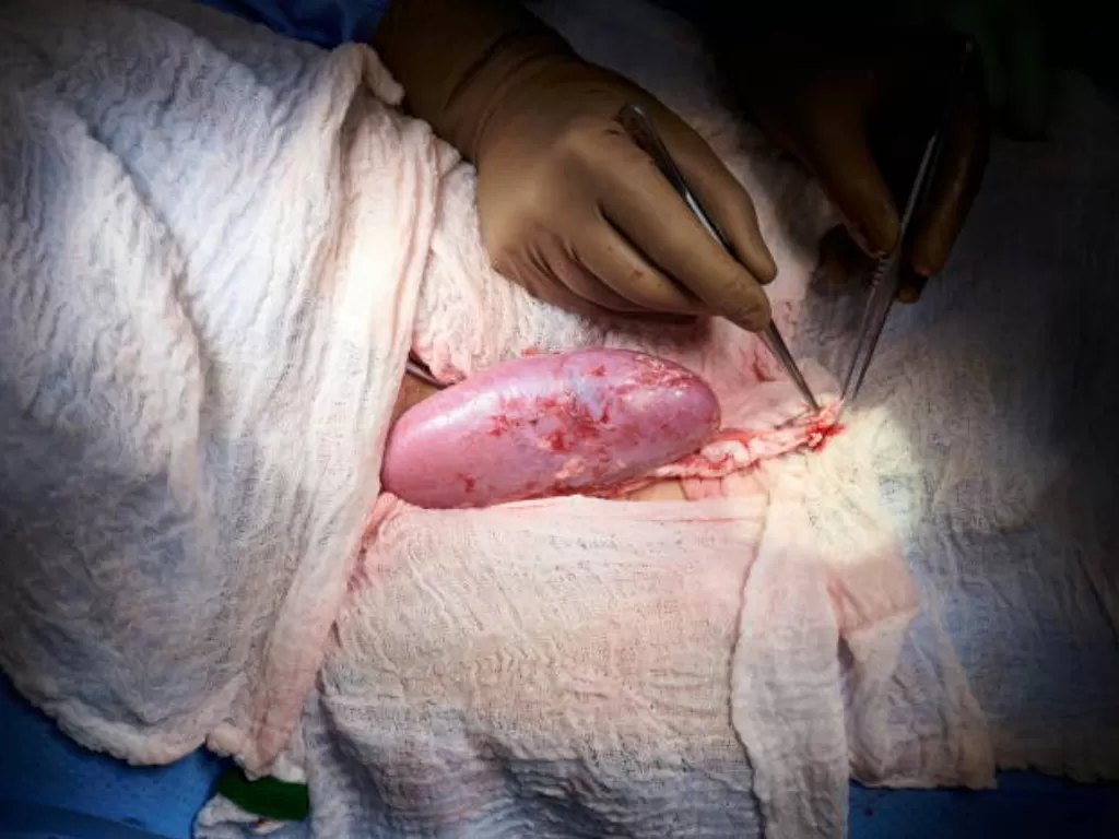 Para dokter yang melakukan transplantasi ginjal babi kepada manusia. (REUTERS/Joe Carrotta for NYU Langone Health Handout/)