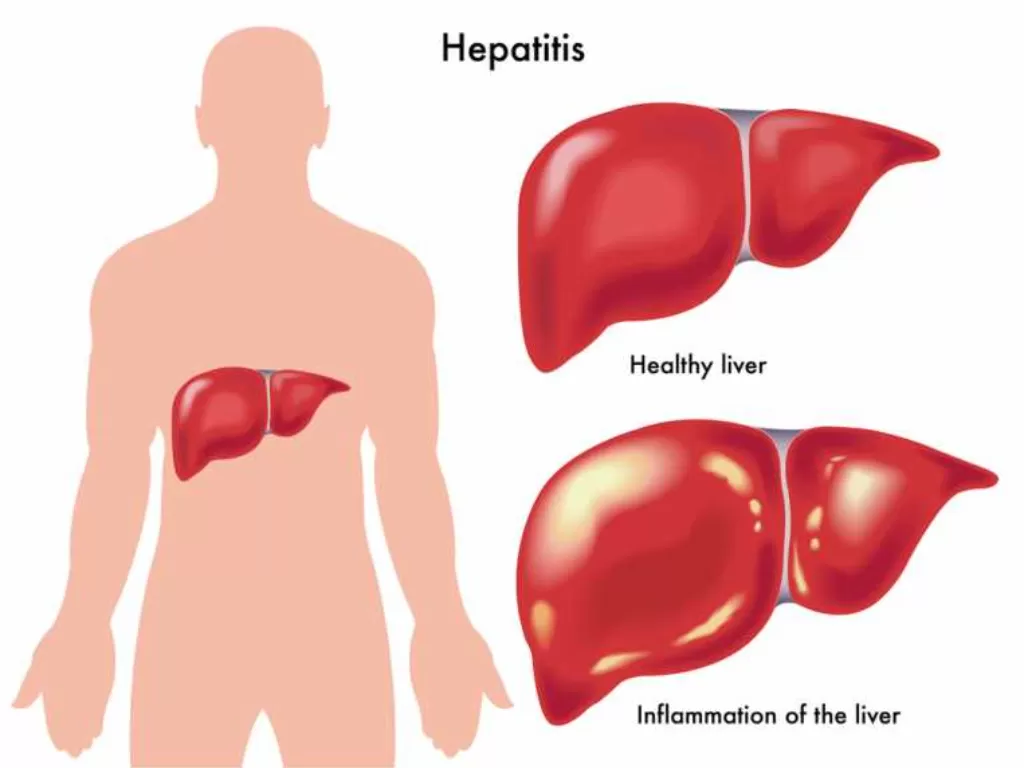 Ilustrasi infeksi liver (Calgarygi.com)
