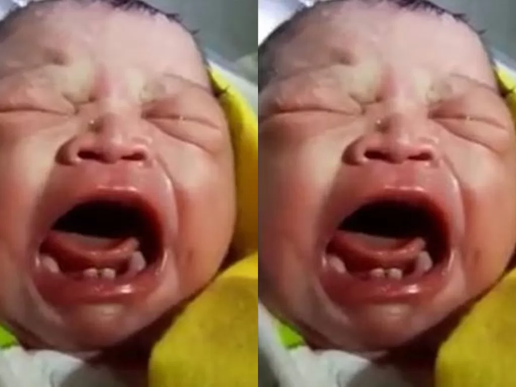 Bayi yang bau saja lahir dengan sejumlah gigi. (ANTARA/HO/Ishak)