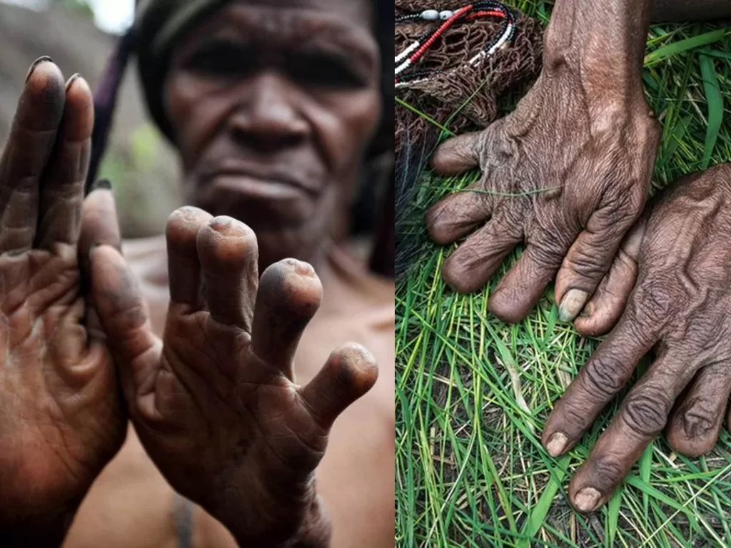 Tradisi Iki Pelek ala Suku Dani Papua (Dok. Shutterstock/Chris piason)