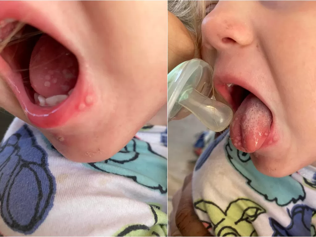 Balita yang mengalami herpes setelah dicium. (Instagram/@tinyheartseducation)