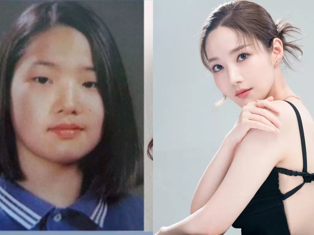 Park Min-young sebelum dan sesudah operasi plastik. (channel-korea/Instagram/@rachel_mypark)