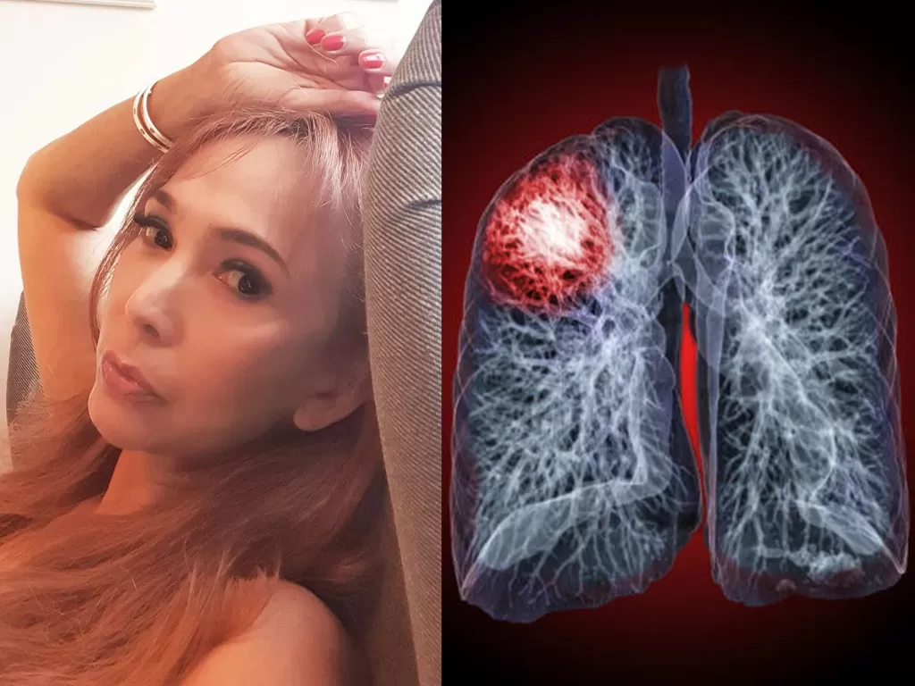 Kolase foto Kiki Fatmala dan ilustrasi kanker paru (Instagram/qq_fatmala/Freepik/rawpixel.com)