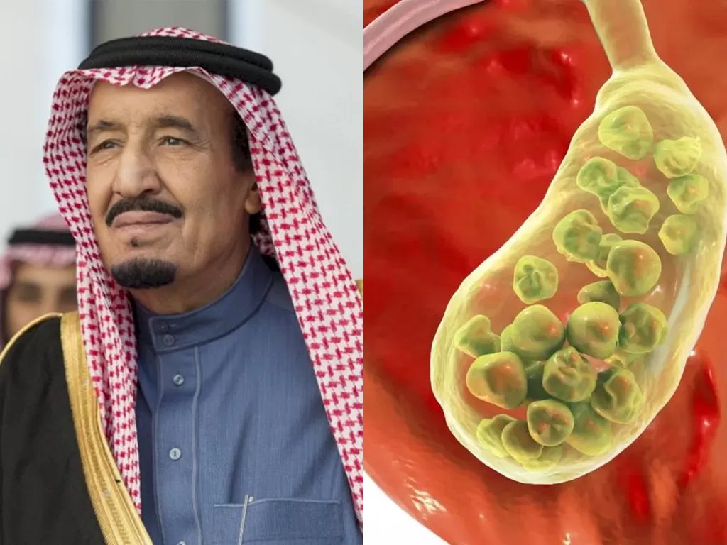 Raja Salman mengalami radang kantong empedu. (REUTERS/Bandar al-Jaloud/Medical News Today)