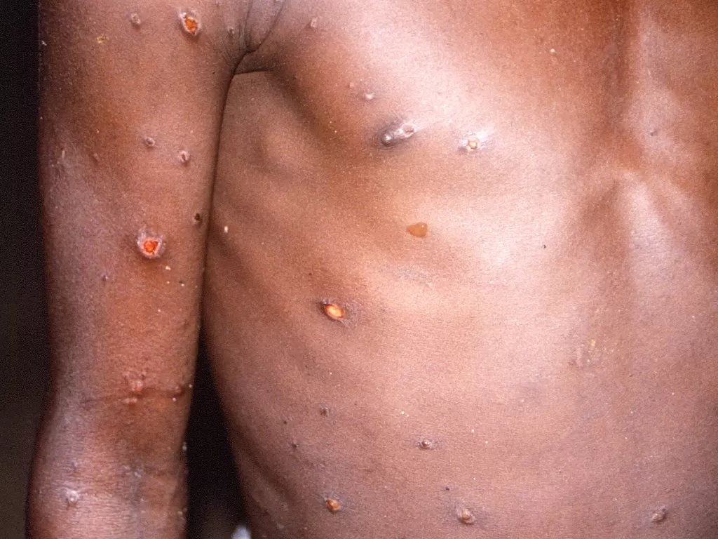 Cacar monyet atau monkeypox. (REUTERS/CDC/BRIAN W.J. MAHY)