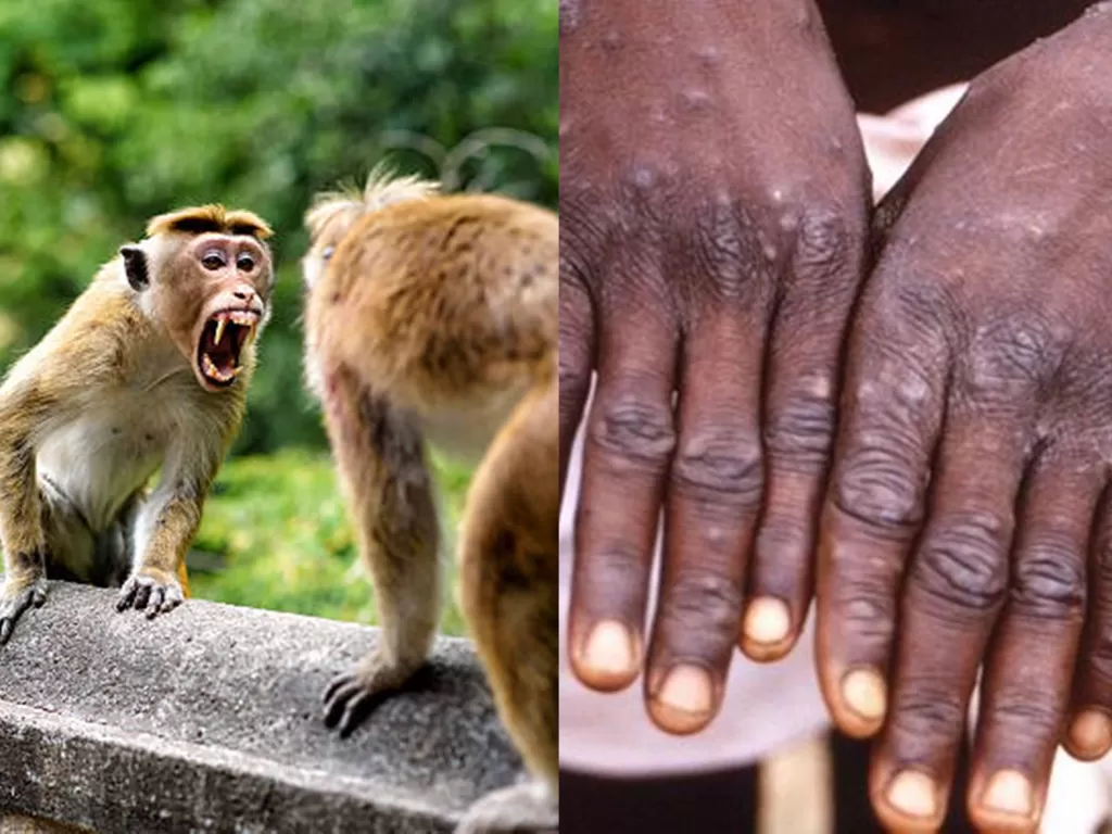 Ilustrasi cacar monyet (Unsplash/Cameris/REUTERS/CDC/BRIAN W.J. MAHY).
