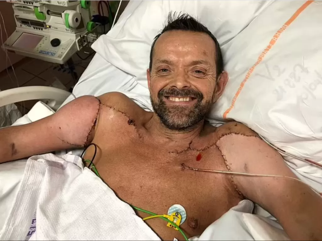 Felix Gretarsson, 49, tersenyum saat transplantasinya dinyatakan berhasil. (Gelix Gretarsson/SWNS via Daily Mail)