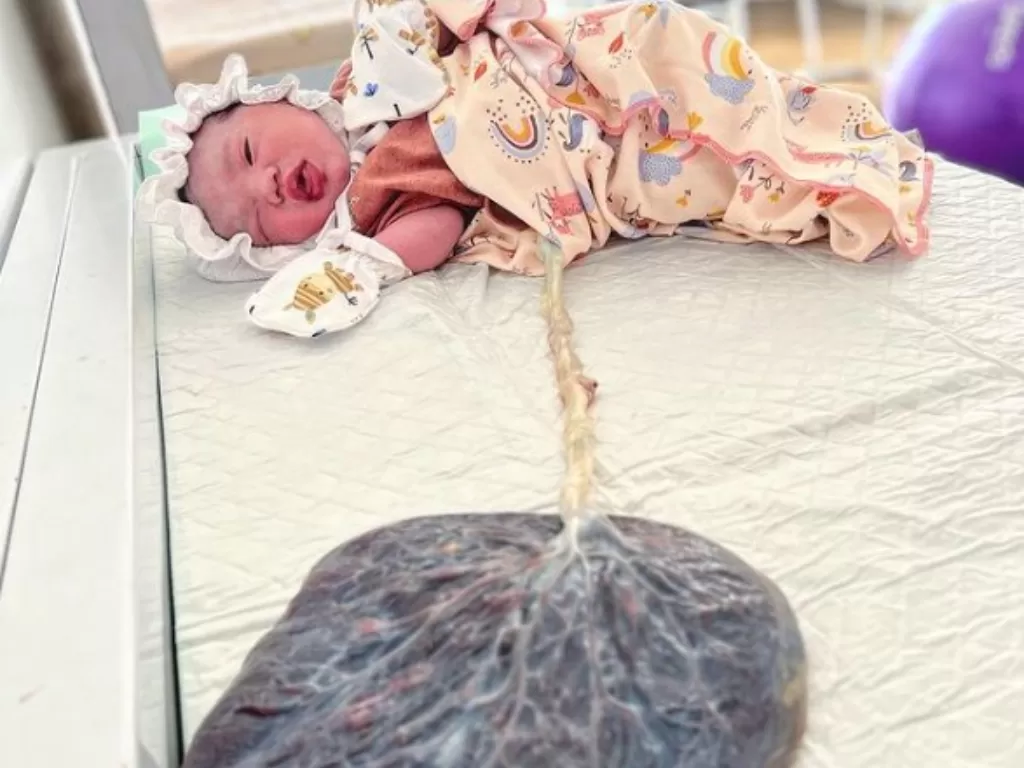 Plasenta masih tersambung dengan pusar usai kelahiran bayi. (Foto/Instagram/Bidan Novel)