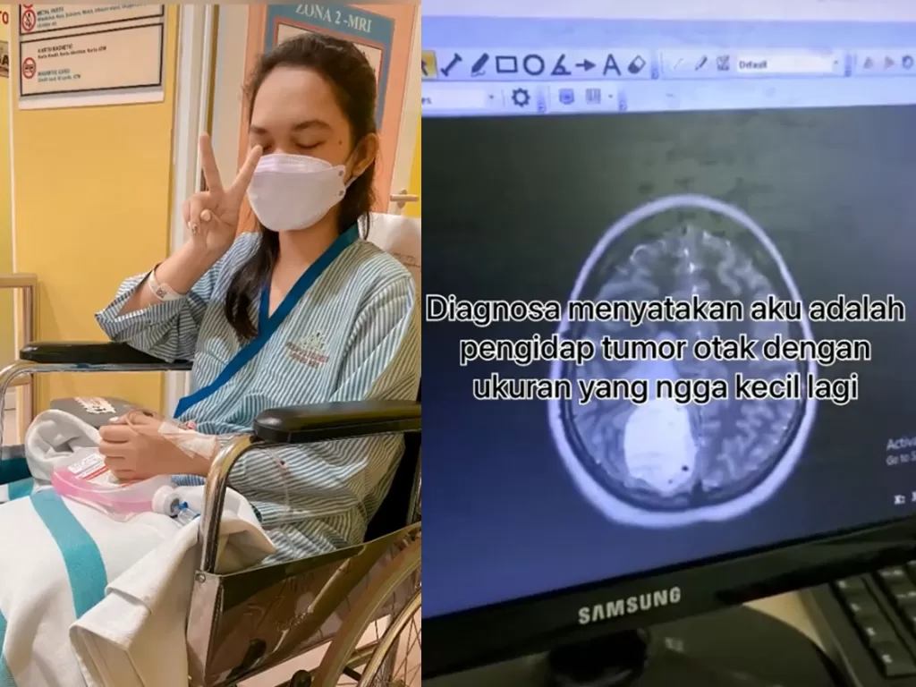 Remaja 20 tahun mengidap tumor otak (TikToknya/@franziskaelva_ )
