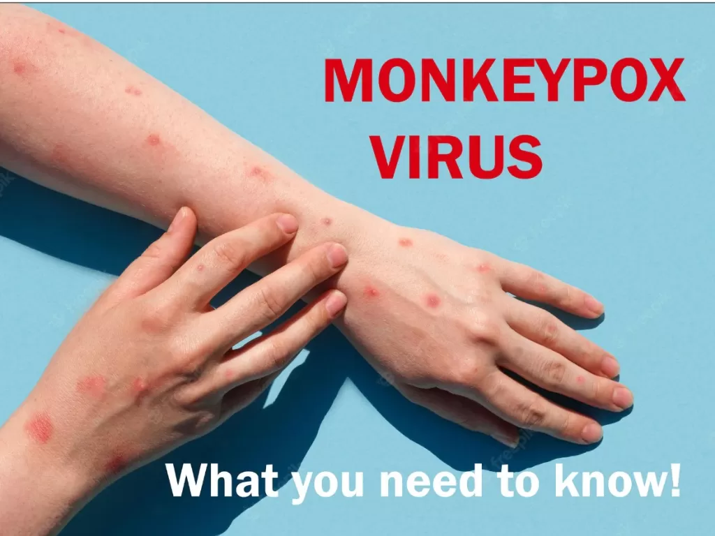 Ilustrasi cacar monyet atau monkeypox. (Freepik/marinademidiuk).