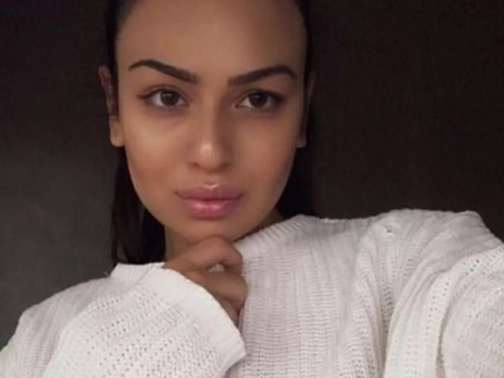 Karolina Sarkisyan, wanita yang mengalami gagal operasi plastik hidung (Newsflash)