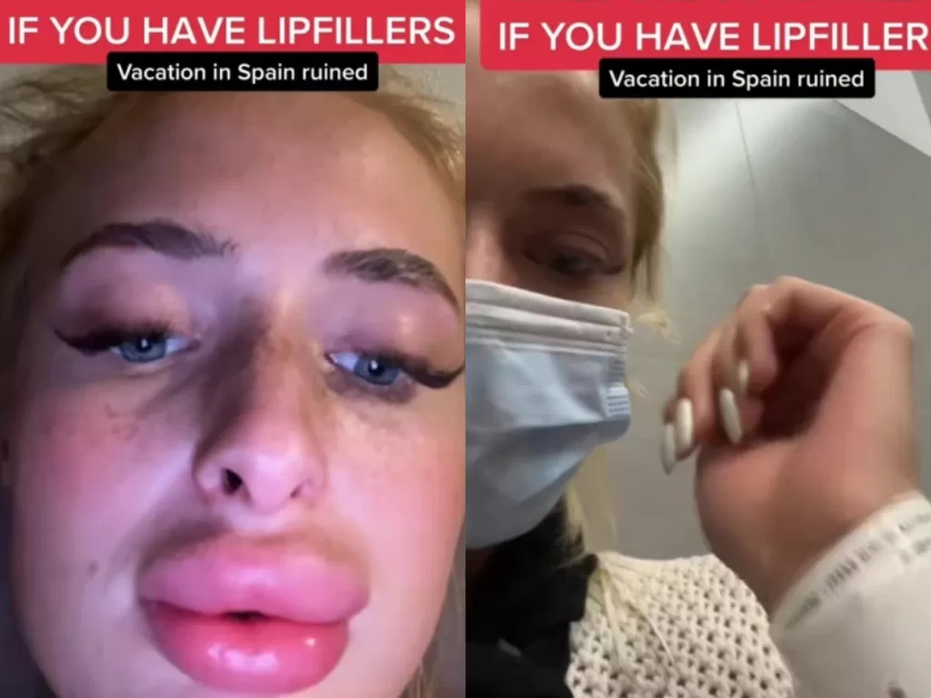 Seorang wanita mengalami pembengkakan bibir usai suntik filler. (TikTok/@isabellaskeel)