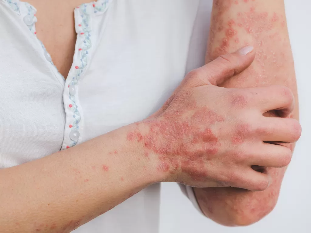Penyakit kulit (pixabay/Miller_Eszter)