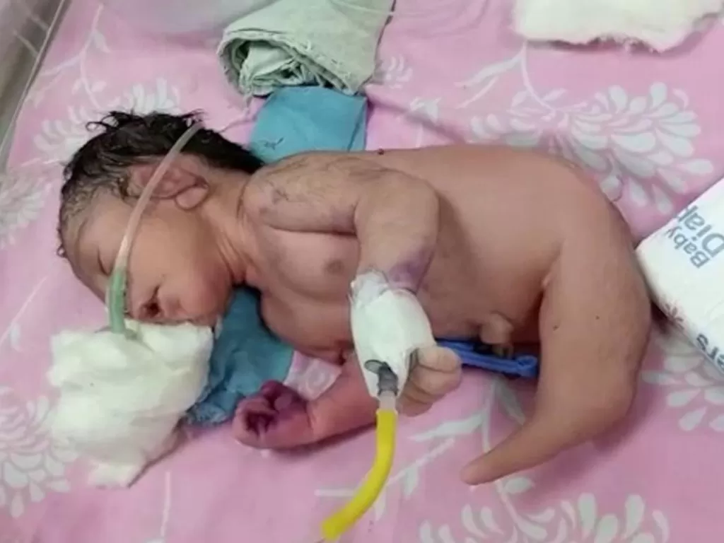 Bayi lahir dengan kondisi langka. (India Times)