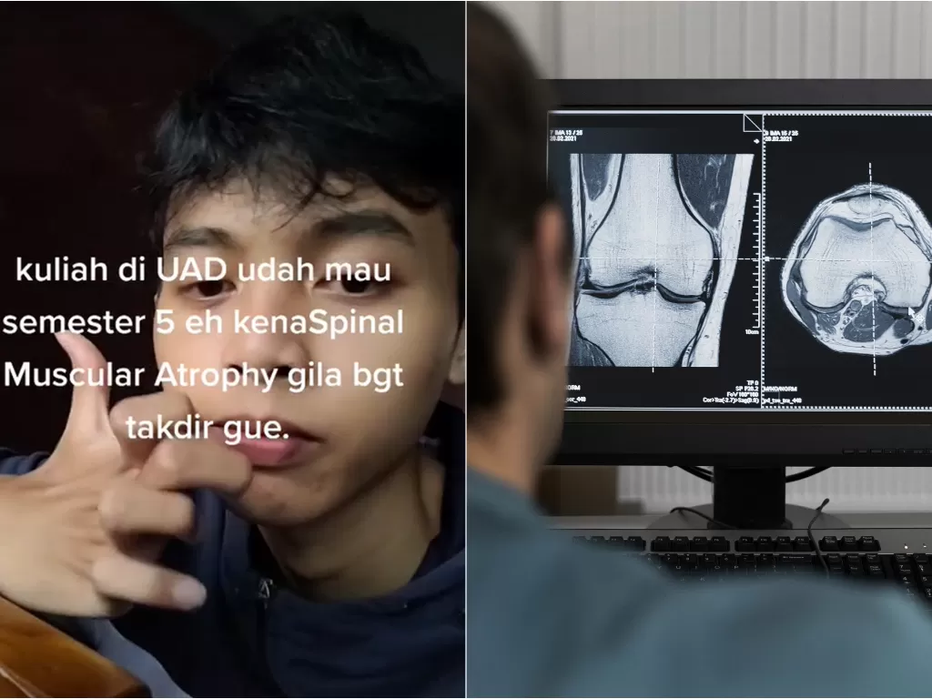 Mahasiswa idap spinal muscular atrophy. (TikTok/ober0n__/FREEPIK)