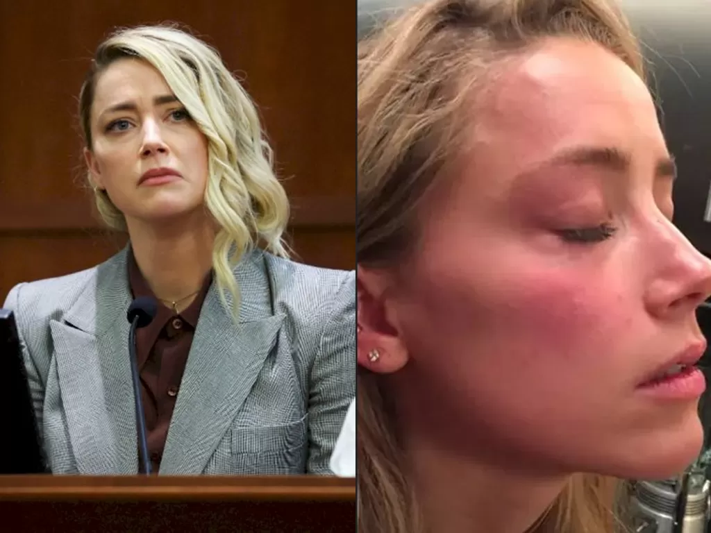 Amber Heard dan foto luka memar yang pernah ditunjukkan di persidangan (REUTERS/Michael Reynolds/Fairfax County Circuit Court)