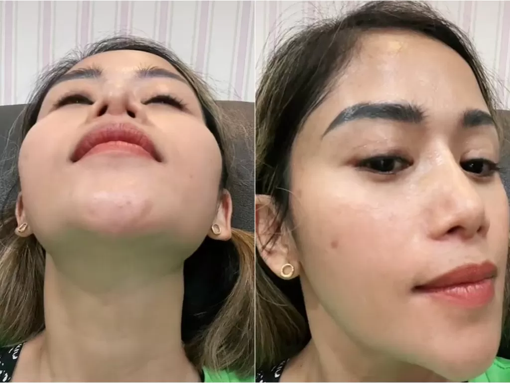 Hidung Farida Nurhan usai operasi plastik. (TikTok/@farida.nurhan)