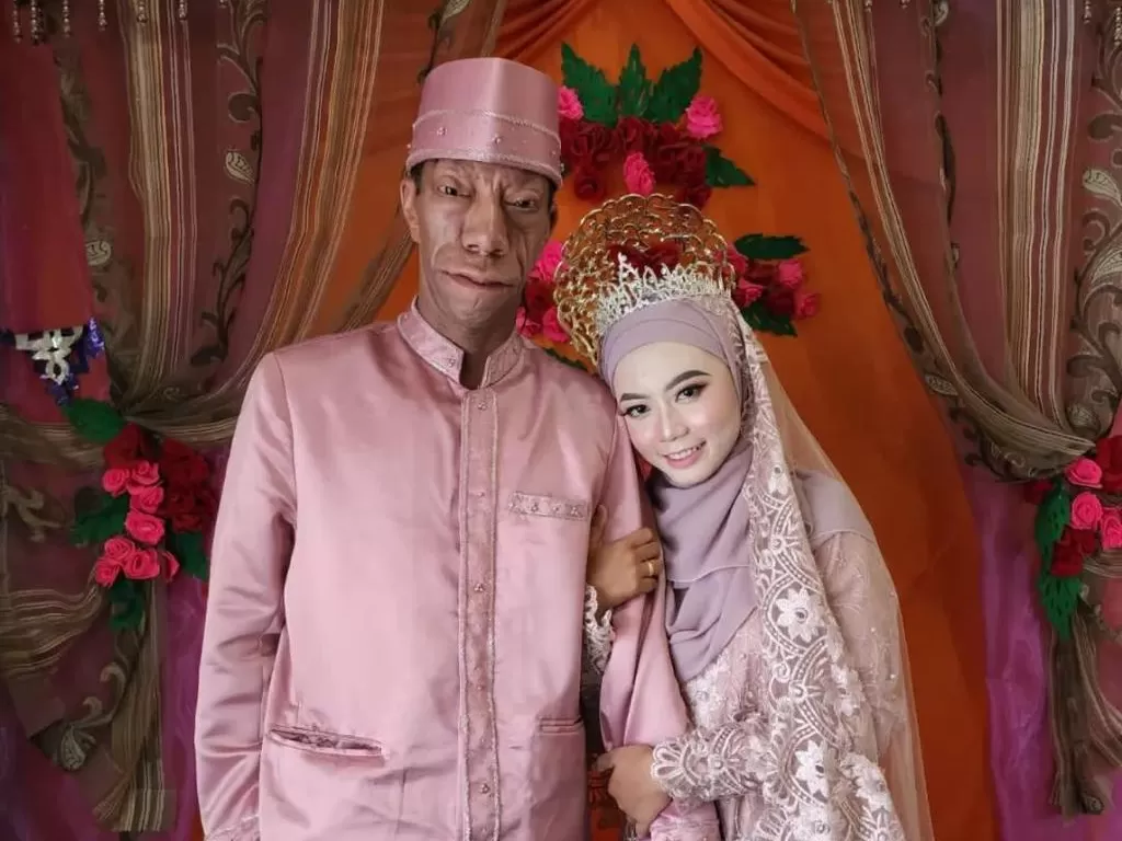 Pengidap Treacher Collins Syndrome, Surya Manurung, dan Istrinya Shasa, telah resmi menikah. (Instagram/shasapuspitaofficial)